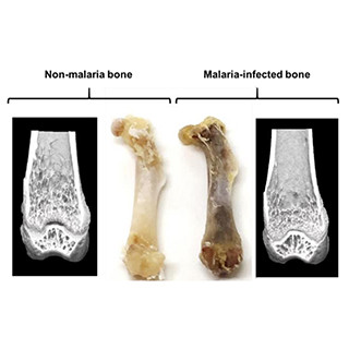 マラリア感染が、完治後も骨量減少の原因となることを発見-大阪大学