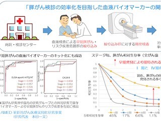 国立がん研、膵臓がんの早期発見へ向けた新しいバイオマーカーの臨床研究