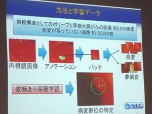 AIで大腸がんおよびポリープを98%検出するシステム開発 - 国がん・NEC