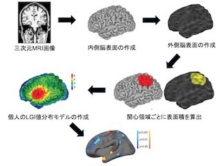 富山大など、後頭葉の脳回形成の変化が統合失調症発症を予測することを解明