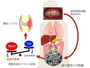 新潟大、歯周病が関節リウマチなどを引き起こす関連メカニズムを解明