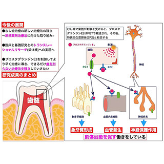 歯の神経の創傷治癒を促すメカニズムを解明-できるだけ削らない治療へ