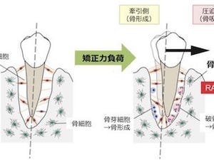 矯正歯科治療における歯の移動の新たなカギとなる細胞を解明 - 医科歯科大