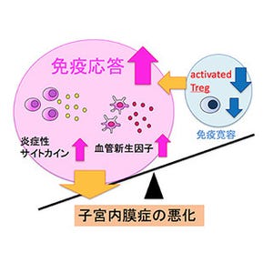 京都府立医科大、子宮内膜症の進展機序を解明