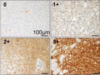 名大、神経膠腫の悪性化に大きく関与する重要分子を発見-新治療標的に期待