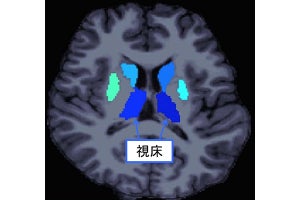 統合失調症における社会機能障害、大脳皮質下領域が関与