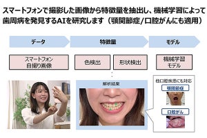 歯周病の早期発見を可能とするAIの開発に向け東北大とドコモが協力