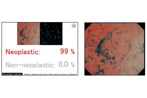 オリンパスがAI搭載の内視鏡画像診断支援ソフト