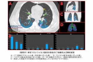 富士フイルム、AIで新型コロナの診断支援技術開発をスタート