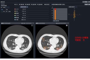 新型コロナウイルス診断を支援するAI技術の共同研究