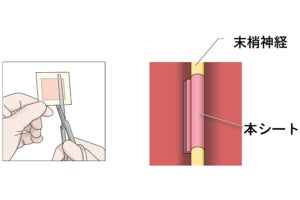 傷ついた末梢神経の再生を促す薬剤を含有したシート、阪大などが治験を実施