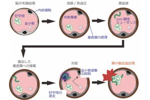 むし歯の原因菌が脳内出血を引き起こす遠因となることを国循などが発見