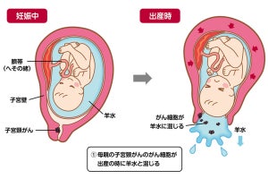 母親の子宮頸がんが子どもの肺に移行する現象、国立がん研究センターが発見