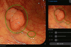 NECが大腸がんの早期発見に向けた内視鏡画像解析AIを開発・販売