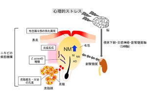 東薬大など、ニキビと患者の心理的ストレスとの関連性を科学的に証明