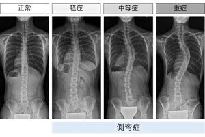 理研など、「思春期特発性側弯症」の発症や重症化を予測する手法を開発