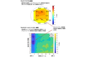 千葉工大、アルツハイマー病などの神経回路の変質を推定するアルゴリズムを開発