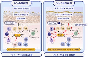 「樹状細胞」がアトピー性皮膚炎の悪化を防ぐ役割であることを宮崎大が確認