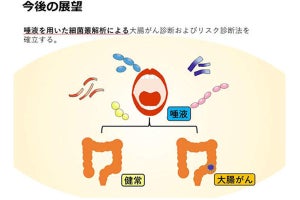 口腔細菌が大腸がんの発生に関与している可能性、鹿児島大が発見