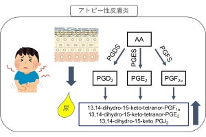 東大、アトピー性皮膚炎の尿中で濃度が上昇している脂質代謝物3種類を発見