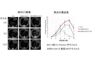 新型コロナとインフルエンザの重複感染で肺炎の重症化の可能性、長崎大