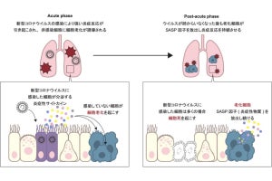 新型コロナの後遺症は感染細胞周囲の細胞老化が関係している、阪大が確認