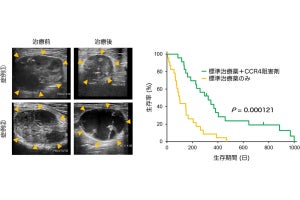 東大、進行性前立腺がんの仕組みの解明による新たな免疫療法の実用化に前進