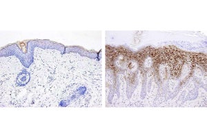 慢性皮膚炎で大量生産されるペプチドが皮膚のバリアを低下させる、香川大などが確認