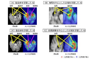 アルツハイマーに軽度認知障害患者が進行するか予測するAI、富士フイルムなどが開発