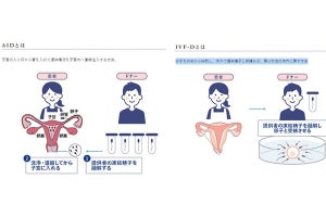 「困っている人、助けられれば」 - 体外受精に使用する精子の一般公募の現在  