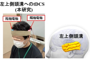 統合失調症患者の社会認知機能が経頭蓋直流刺激で改善、NCNPが確認