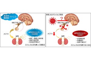 新型コロナの後遺症に副腎皮質ホルモン障害が関わっている可能性、神戸大が報告