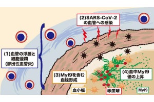 新型コロナの重症化に特定のたんぱく質の濃度が関係、千葉大が確認