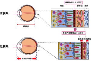 近視の進行抑制には網膜後方の血管の保護が有効、慶大が確認