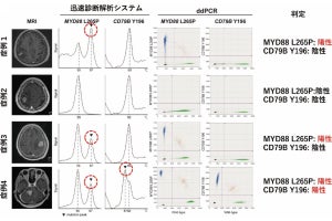 名大、中枢神経系原発悪性リンパ腫の診断を90分で可能とするシステムを開発