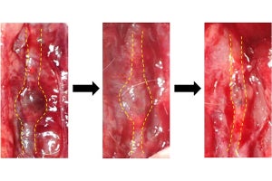 近大が腹部大動脈瘤を縮小させる成分を発見　新たな治療薬創出に期待