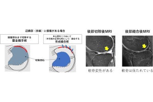 若年者の外側円板状半月板損傷治療は温存療法が効果的　大阪公大が解明