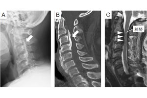 理研など、背骨の疾患「脊柱後縦靱帯骨化症」に関する疾患感受性領域を同定