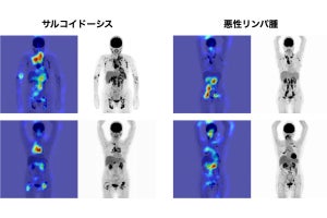 TMDU、困難だったサルコイドーシスと悪性腫瘍を鑑別するAIモデルを開発