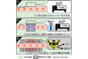 岩手大、脳の血管障害で炎症反応が促進される仕組みの一端を解明