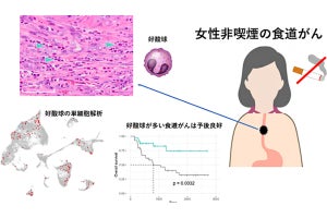 増加傾向にある非喫煙女性の食道がん発症に好酸球が関与 - 理研などが発表