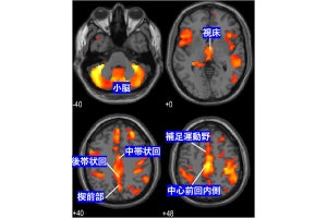 拒食症の重症度と脳灰白質の体積に見られた相関とは - NCNPなどの共同研究