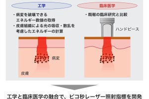 シミ・アザ治療の有効性向上へ、大阪公大などがレーザーの照射指標を開発