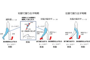 東北大、左脳と右脳の脳卒中では歩行速度低下の要因が異なることを確認