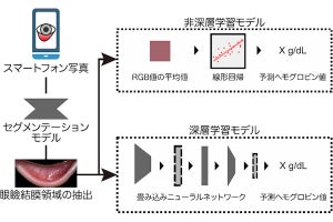 スマホカメラで撮影した眼の結膜から貧血を予測するAIを東大などが開発