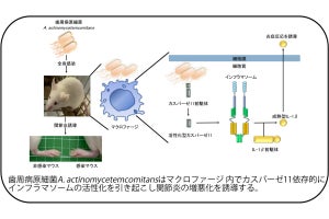 東京医科歯科大、歯周病菌が関節炎を悪化させる仕組みの一端を解明